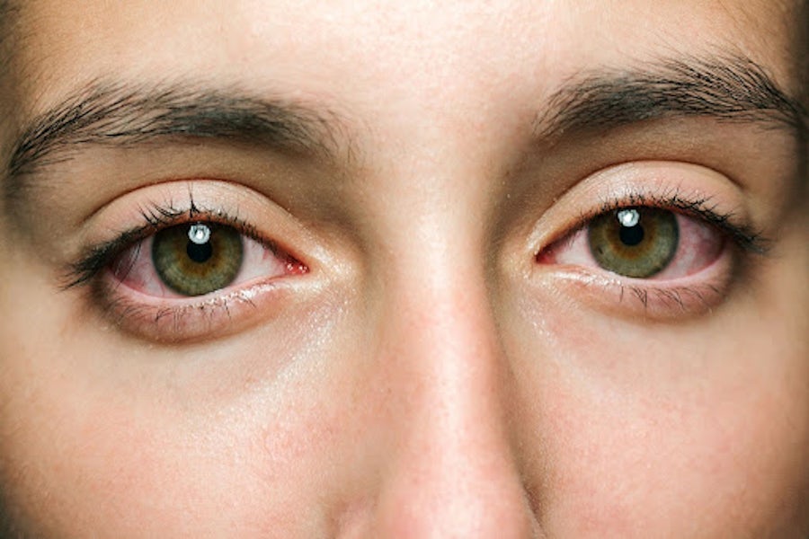 Indirekte Trolley forskel Why Does Cannabis Make Your Eyes Red? | The Cannigma