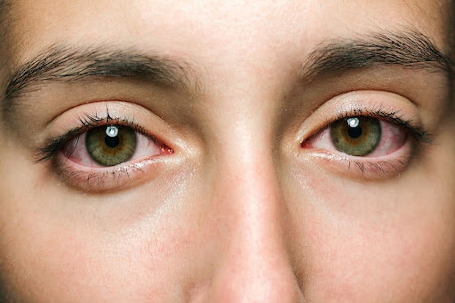 Does Cannabis Make Your Eyes The